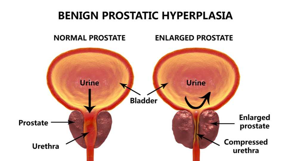 Is it Possible to Prevent Issues Related to Prostate Health As Men Age?